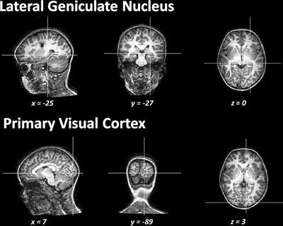 Impact of early brain lesions on the optic radiations in children with cerebral palsy